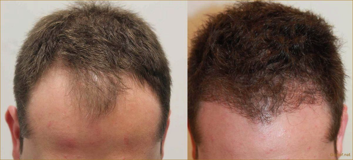 Пересадка волос по методу FUE: технология, преимущества и результаты