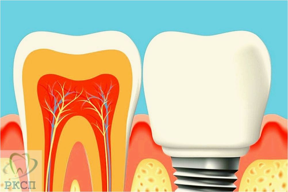 Что нужно знать о «Протезировании зубов»