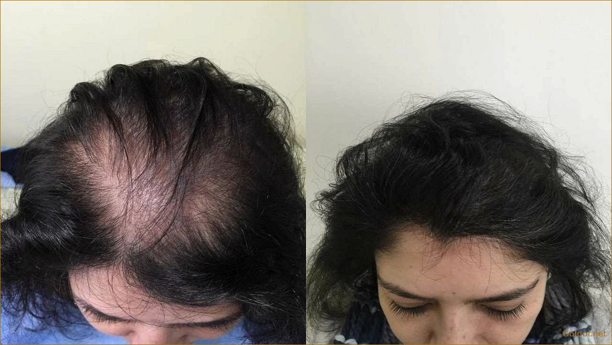 Пересадка волос для женщин: как выбрать качественный метод и добиться эффекта натуральности