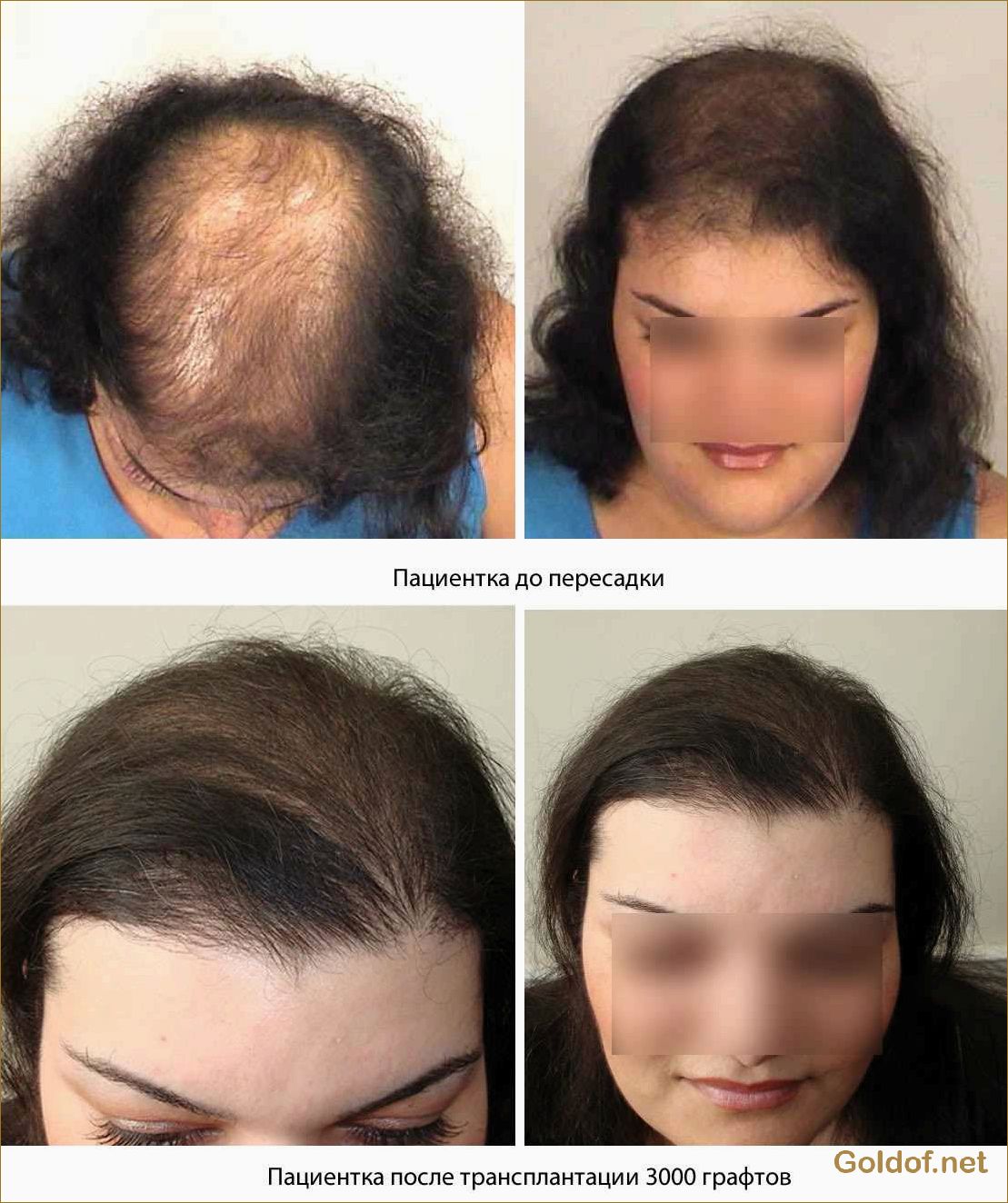 Пересадка волос для женщин: как выбрать качественный метод и добиться эффекта натуральности