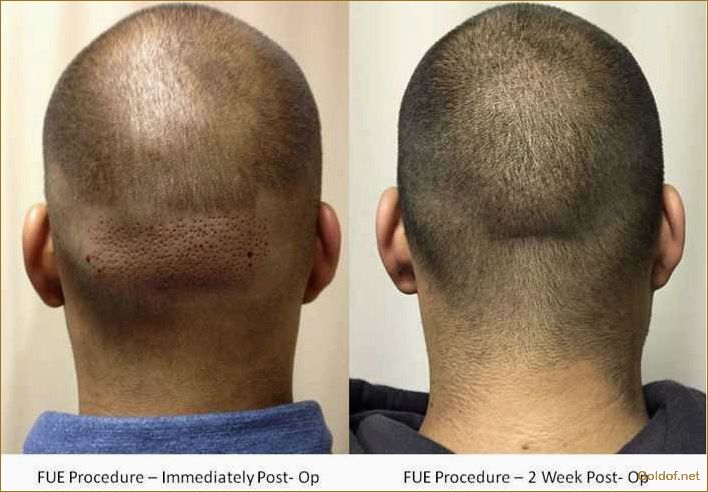 Пересадка волос FUE: особенности и преимущества метода