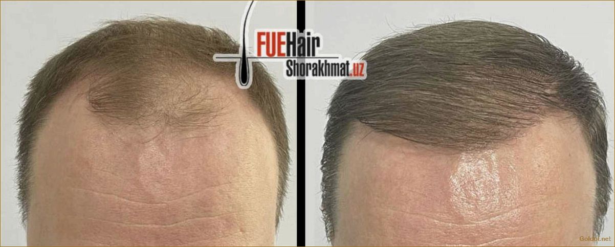 Пересадка волос FUE: особенности и преимущества метода